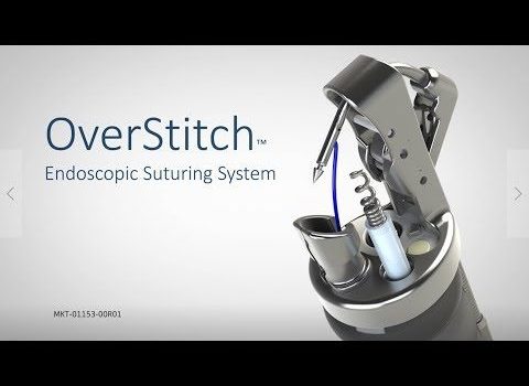 Overstitch - EndoSleeve Apollo Endosurgery