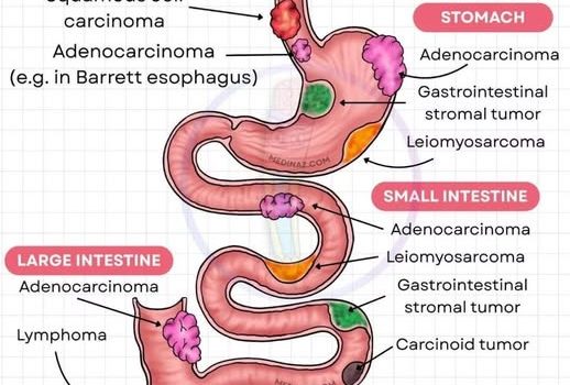 CÁNCERES MÁS FRECUENTES DEL APARATO DIGESTIVO Los cánceres del Aparato Digestivo representan la morbilidad y mortalidad asociadas al cáncer a nivel mundial, representando el 35 % de las muertes anuales. Los seis cánceres más comunes del sistema digestivo: esófago, estómago, vías biliares, páncreas, hígado y colon.
