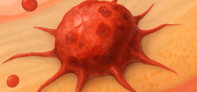 STREPTOCOCCUS ANGINOSUS, UNA NUEVA PESADILLA GÁSTRICA? STREPTOCOCCUS ANGINOSUS 1.- Nueva bacteria ligada al cáncer de estómago que cambia el concepto y la forma de prevenir esta enfermedad.