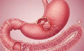 Los Factores Claves en el desarrollo del Cáncer Gástrico. La importancia de la Microbiota Gástrica, Disbiosis Gástrica y la Dieta en la Prevención de su Carcinogénesis.