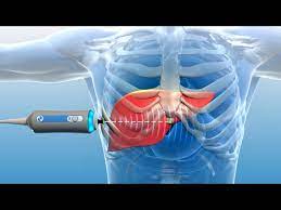 FIBROSCAN    ELASTOGRAFÍA HEPÁTICA