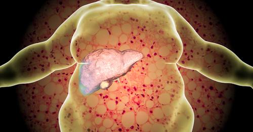 RELACIÓN ENTRE HÍGADO GRASO NO ALCOHÓLICO Y CÁNCER DE HÍGADO.