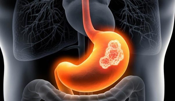 CÁNCER GÁSTRICO