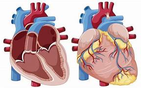 CORAZON GRASO ESTEATOSIS CARDÍACA