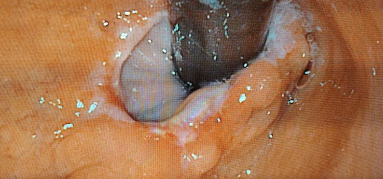 HERNIA HIATAL - ERGE - REFLUJO ESOFAGITIS EROSIVA SEVERA - PREVENCIÓN DEL CÁNCER DE ESÓFAGO.